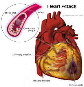 Diagram showing pictoral image of heart attack