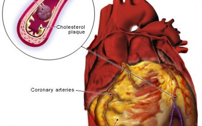 Heart attack symptoms in women, are they different?