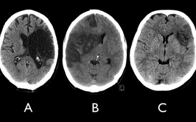 First Aid for Stroke