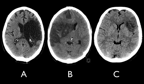 First Aid for Stroke